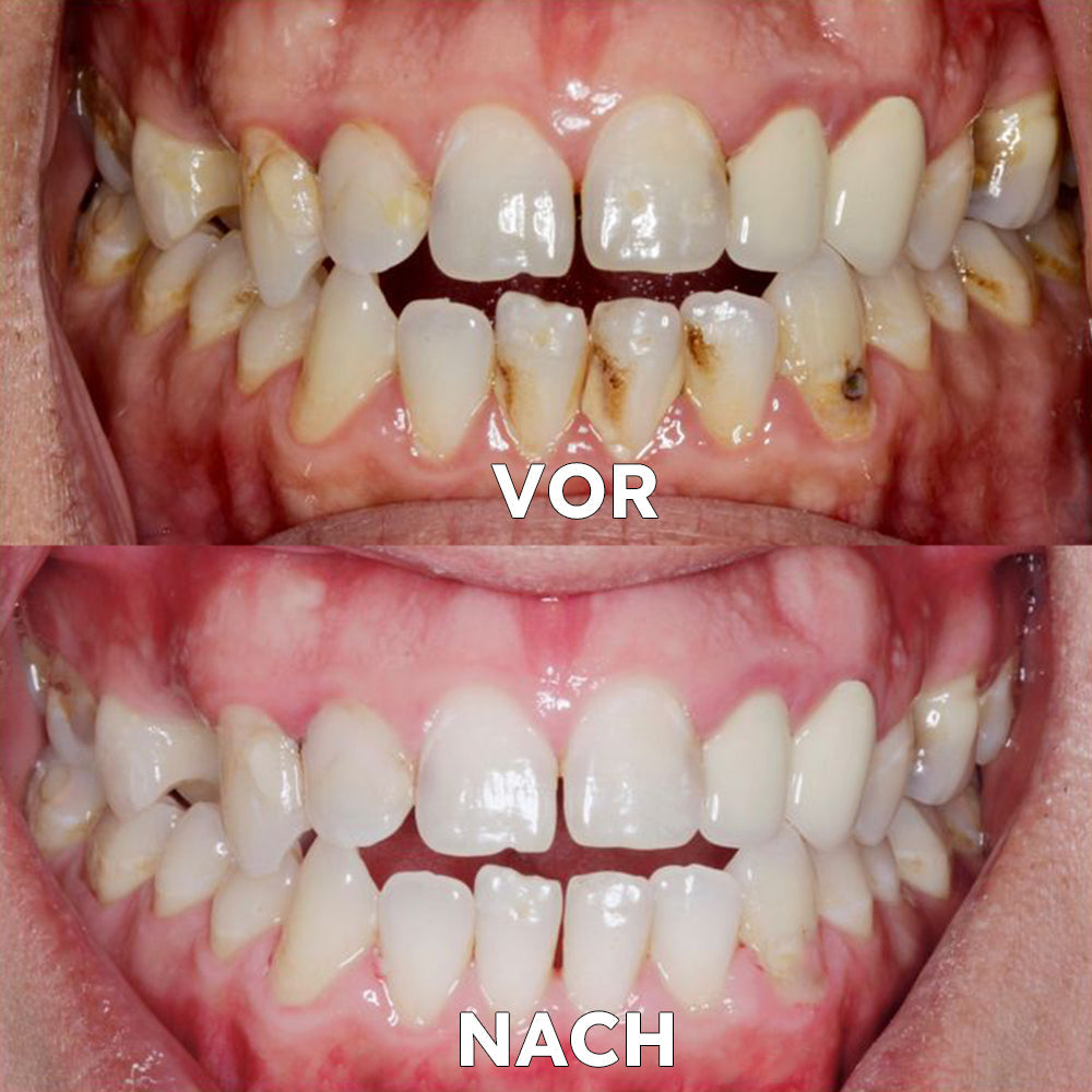 ✅BMEL-Zulassung |Ourlyard™ Kokosöl-Mundspülung mit ätherischem Öl