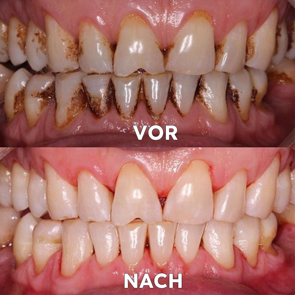 ✅BMEL-Zulassung |Ourlyard™ Kokosöl-Mundspülung mit ätherischem Öl