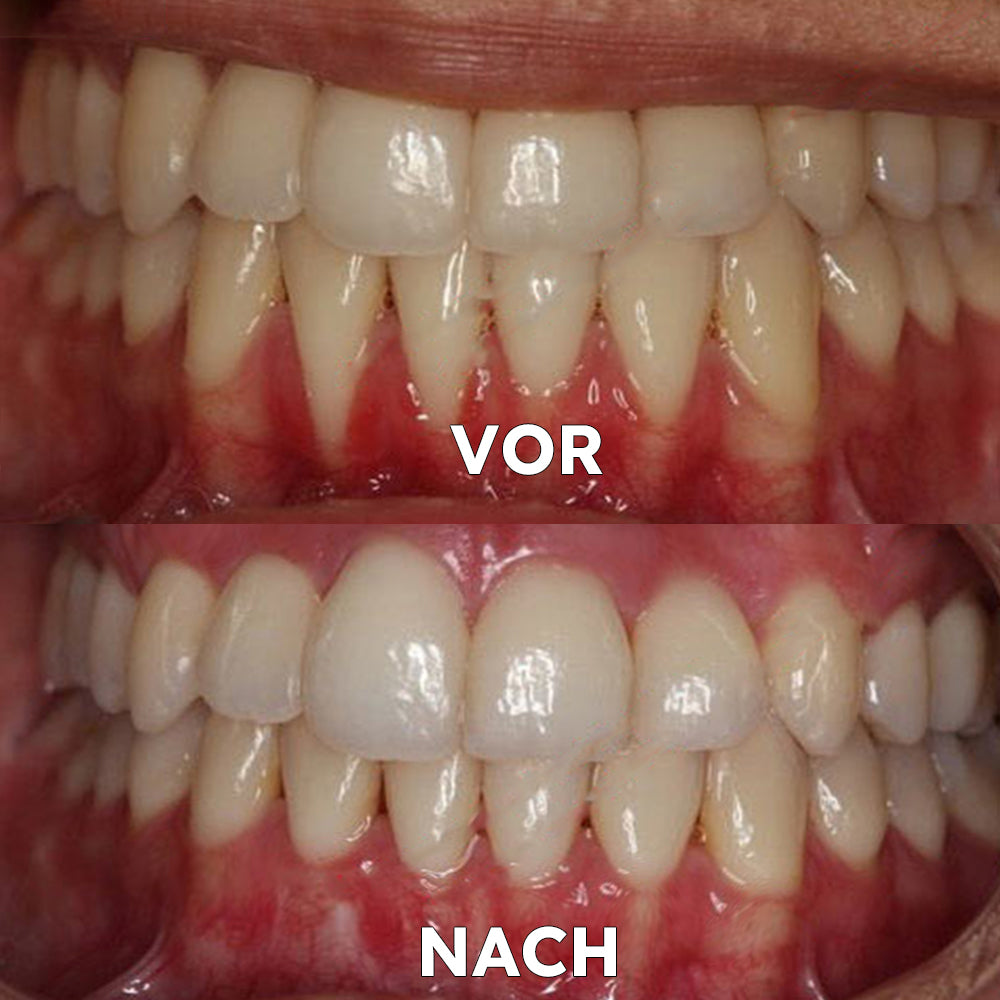 ✅BMEL-Zulassung |Ourlyard™ Kokosöl-Mundspülung mit ätherischem Öl